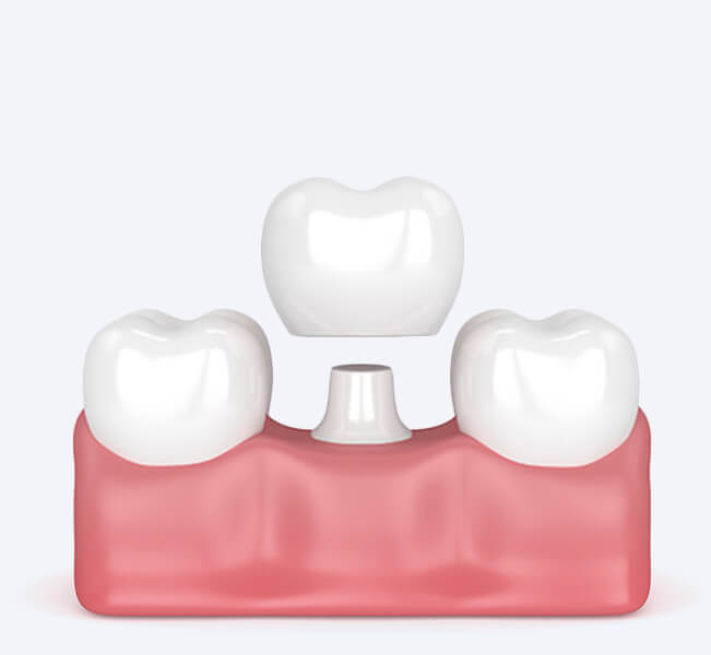 Zahnimplantate modell